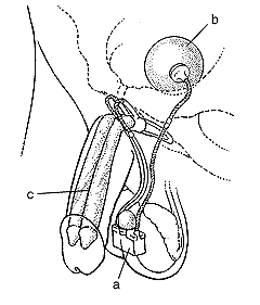 igure 3: Illustration showing inflatable implant